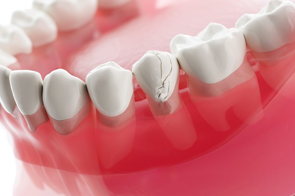 Repair Options For A Broken Tooth