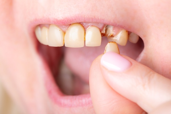 When A Painful Broken Tooth Is An Emergency