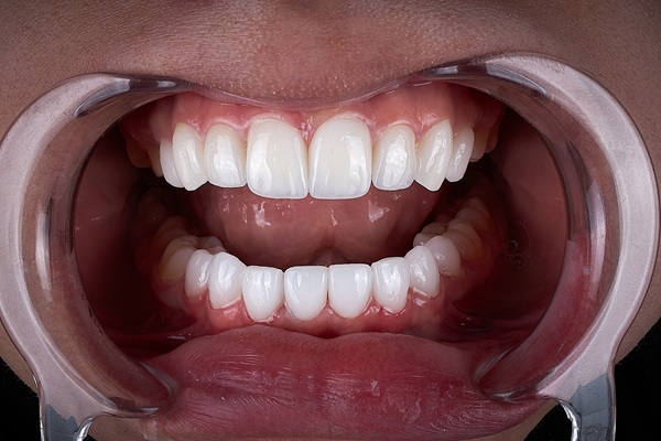 Benefits Of Dental Bonding