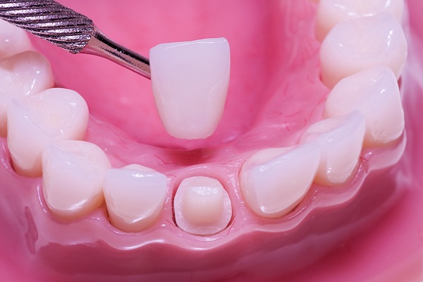 Can A Dental Crown Fall Out?