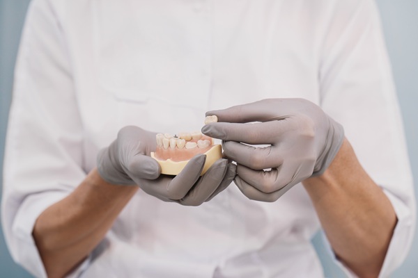 Can A Dental Crown Fail?